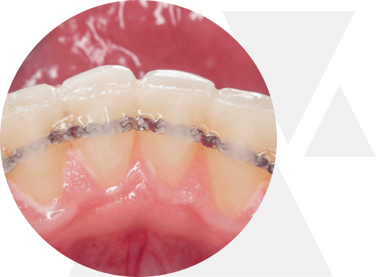 kieferorthopaedie retainer
