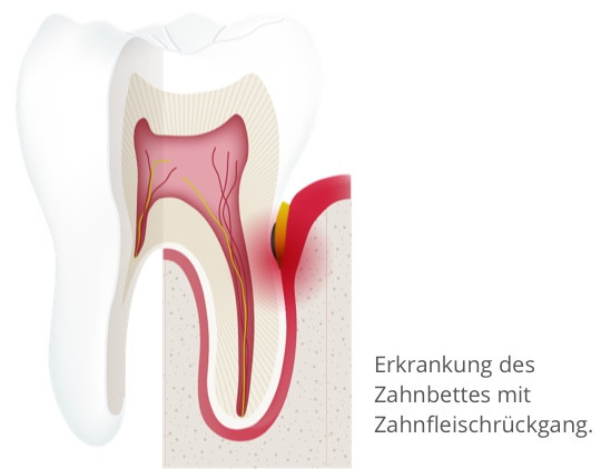 Erkrankung des Zahnbettes mit Zahnfleischrückgang
